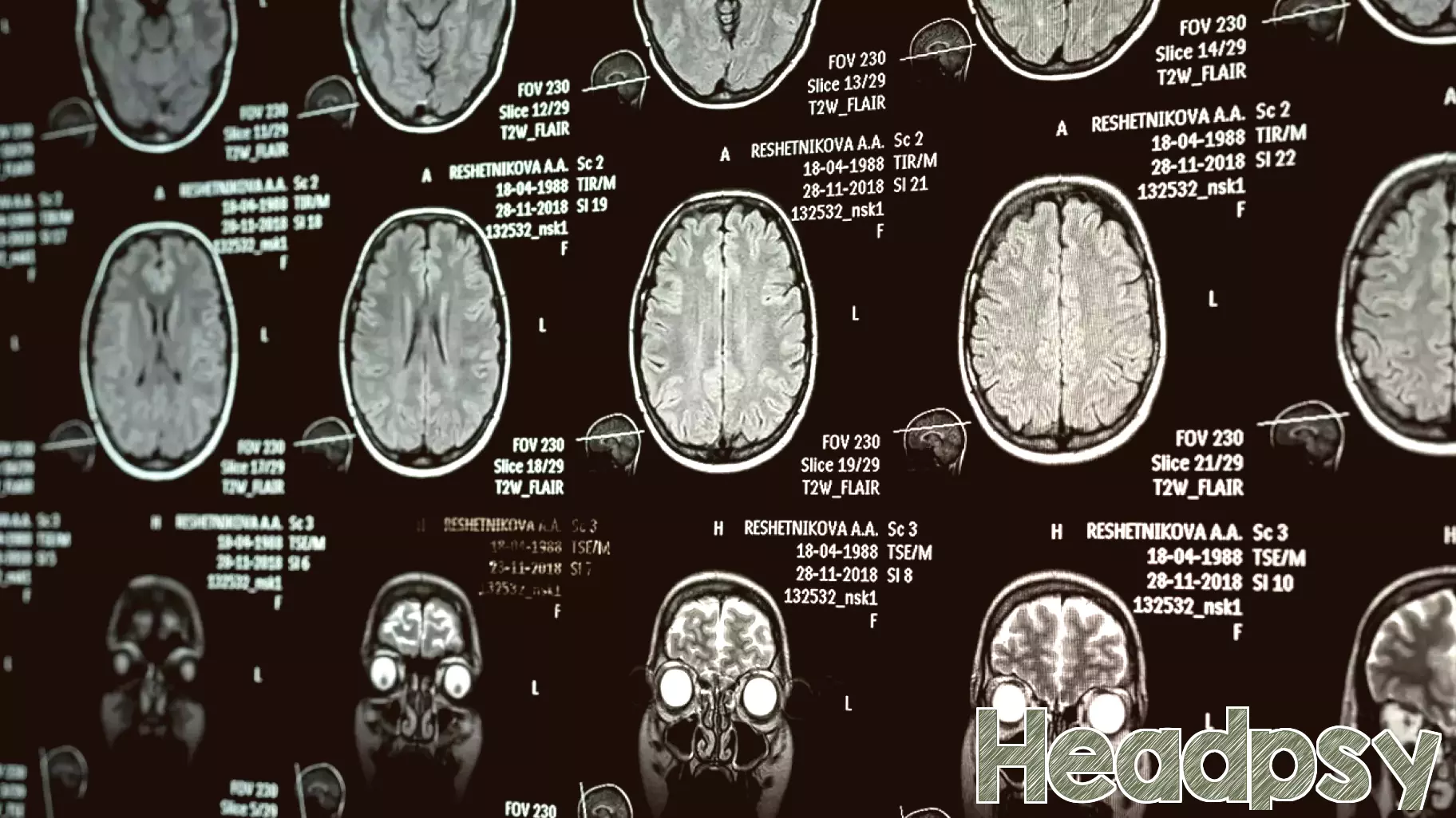 Narcissistic traits are linked to a brain area governing emotional control
